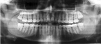 The panorama x-ray image made during the consultation