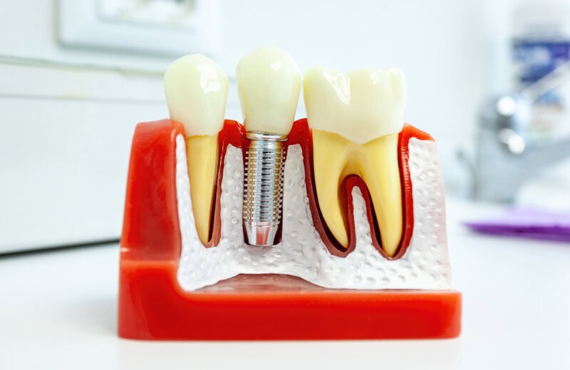 A beültetett fogászati implantátumot a megfelelő gyógyulási idő letelte után látják el végleges pótlással. Ez a pótlás szükség esetén lehet korona vagy híd, a helyzettől függően. Bizonyos esetekben a gyógyulási folyamat eltérhet a szokásostól, vagy kiegészítő beavatkozásokra lehet szükség.