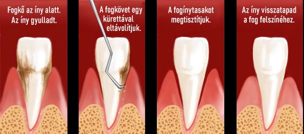 A fogászati kürettálás egy professzionális, mély ínytisztítás, melynek célja az íny alatti területek megtisztítása a baktériumoktól, a lepedéktől és a fogkőtől. Általában fogágybetegség (parodontitis) esetén alkalmazzák, amikor a fog és az íny között egy kis rés alakul ki, amely lehetőséget teremt a baktériumok és a fogkő megtelepedésére.